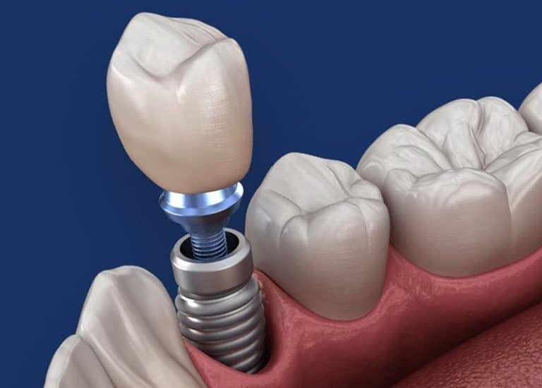 Un dinte cu implant dentar in el, situat in Rahova, Sector 5.