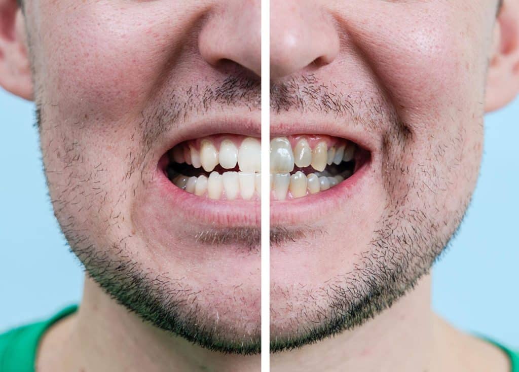 Dintii inainte si dupa albirea dintilor la un stomatolog din sectorul 5.