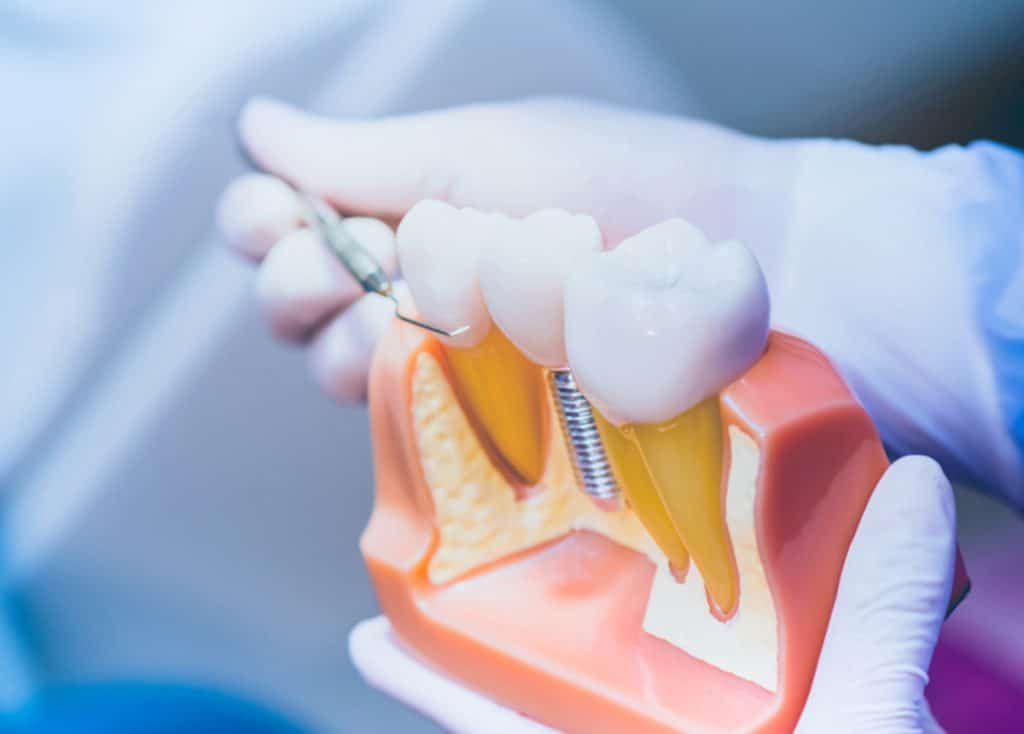 Un stomatolog din Sectorul 5, Bucuresti tine in brate o macheta de implant dentar.