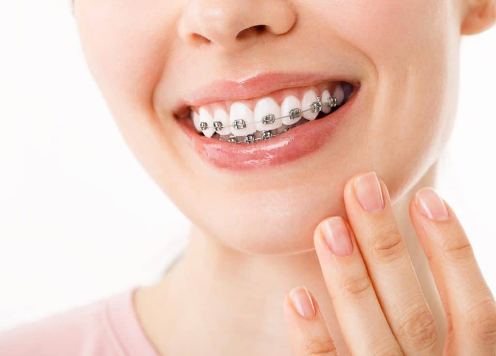 O femeie cu aparat dentar pe dinți în vizită la un stomatolog din Rahova, Sector 5.