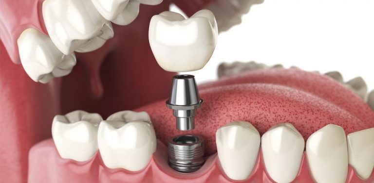 Un implant dentar este plasat în gura unui pacient în Sectorul 5, Bucureşti.
